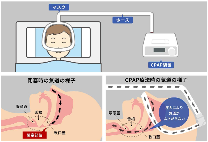 CPAP療法の様子