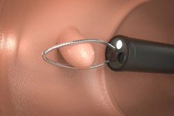 内視鏡を使った日帰り大腸ポリープ切除の処置イメージ