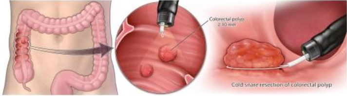 手術方法 コールドスネアポリペクトミー(Cold snare polypectomy)のイメージ