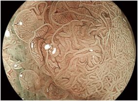 大腸の拡大画像
