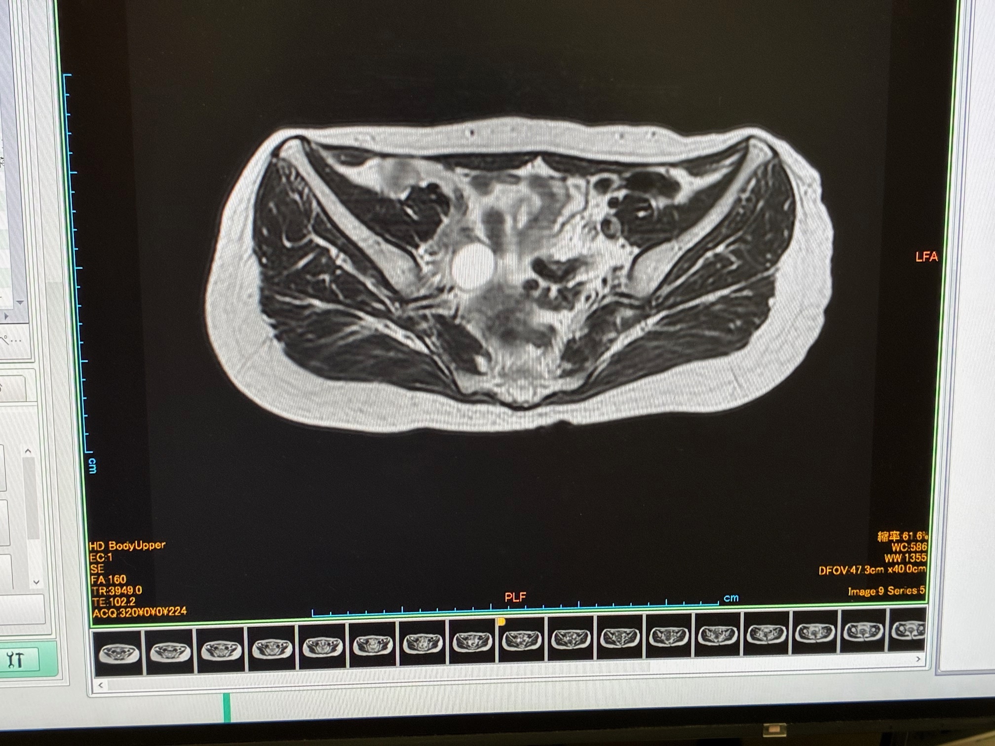 MRI